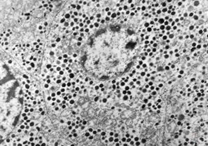 F, 71y. | carcinoid … metastasis to lymphonode F, 71y. | carcinoid … metastasis to lymphonode